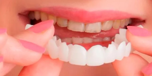 Carillas dentales cosmética Snapon Smile