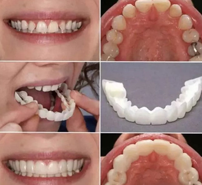 Carillas dentales cosmética Snapon Smile